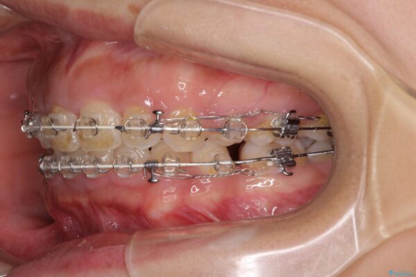 口がしっかりと閉じられない　ワイヤー装置での抜歯矯正で出っ歯を改善 治療途中画像