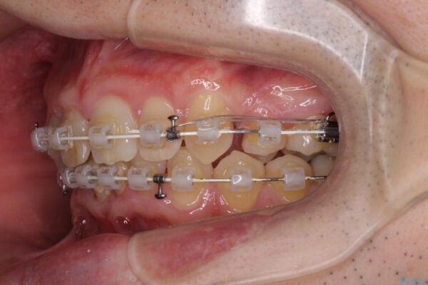 前歯が折れたついでに歯並びも改善　矯正治療と前歯のセラミック治療 治療途中画像