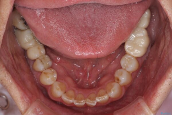 憧れの白い歯に　全顎セラミック治療 治療前画像