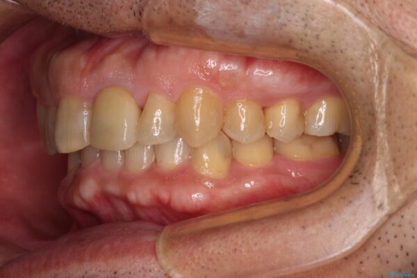 欠損歯列の矯正治療とインプラント治療 治療後画像