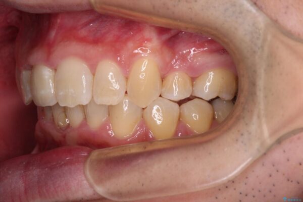 前歯が折れたついでに歯並びも改善　矯正治療と前歯のセラミック治療 治療後画像