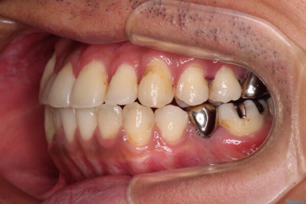 前歯のクロスバイトを改善　インビザライン矯正 治療途中画像