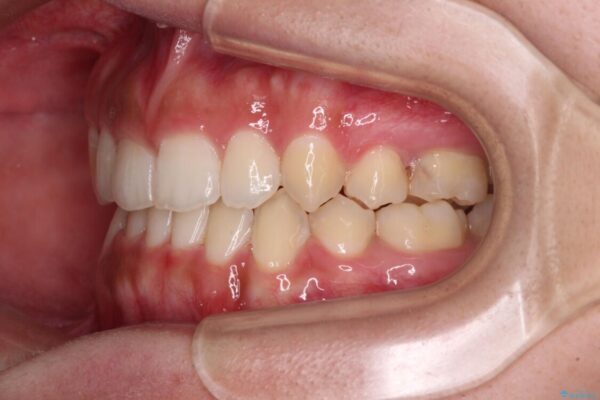 著しい八重歯が気になる　インビザラインによる抜歯矯正治療(ワイヤー装置併用) 治療途中画像