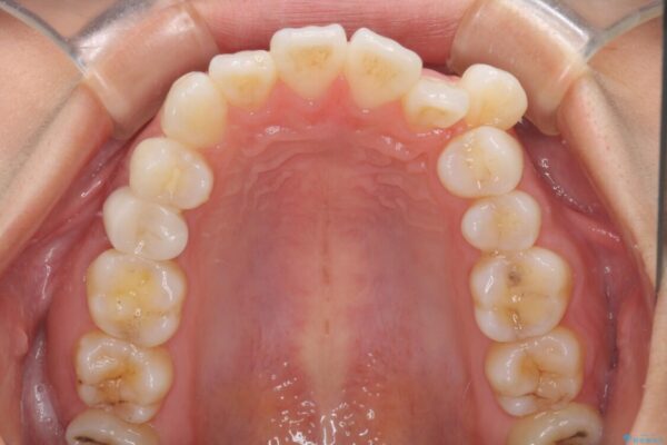 【モニター】気になる八重歯を素早く改善　ワイヤー装置での抜歯矯正 治療前画像