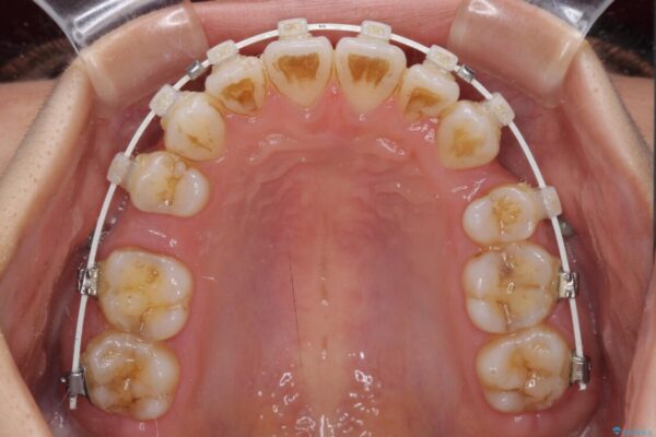 【モニター】気になる八重歯を素早く改善　ワイヤー装置での抜歯矯正 治療途中画像