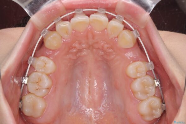 【モニター】八重歯とデコボコをスッキリきれいに　ワイヤー装置での抜歯矯正 治療途中画像