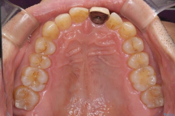 欠損歯列の矯正治療とインプラント治療 治療途中画像