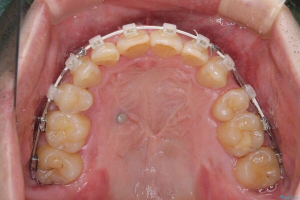 前歯が折れたついでに歯並びも改善　矯正治療と前歯のセラミック治療 治療途中画像