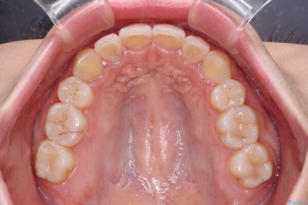 【モニター】八重歯とデコボコをスッキリきれいに　ワイヤー装置での抜歯矯正 治療後画像