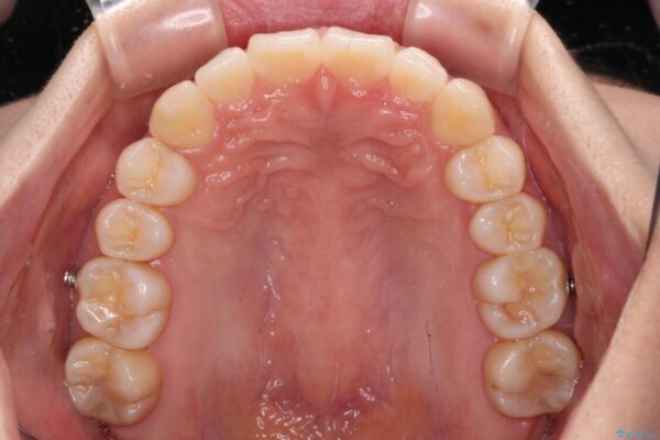 【モニター】すきっ歯をインビザラインで解消 治療途中画像