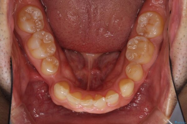 欠損歯列の矯正治療とインプラント治療 治療前画像
