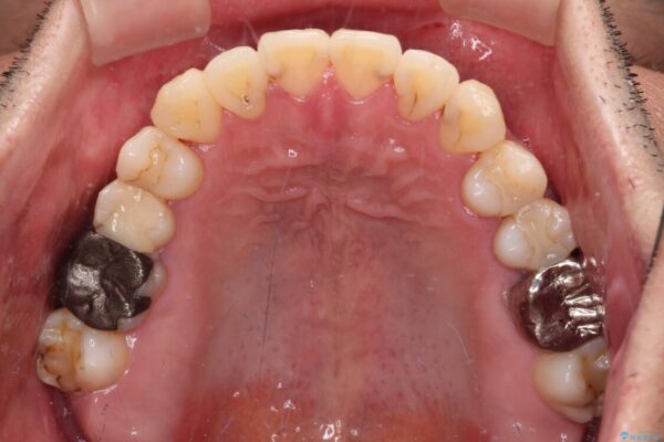 前歯のクロスバイトを改善　インビザライン矯正 治療後画像