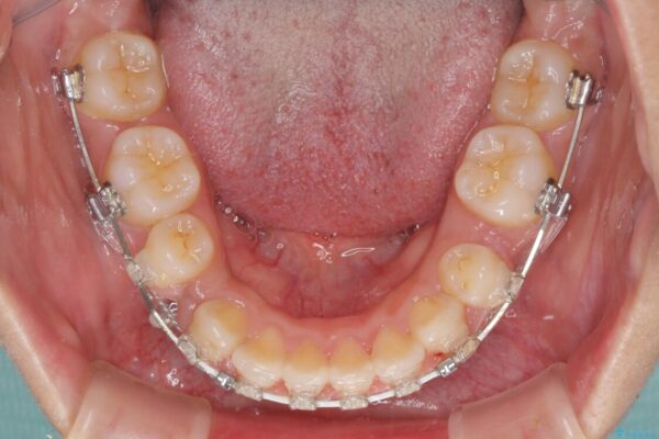 口がしっかりと閉じられない　ワイヤー装置での抜歯矯正で出っ歯を改善 治療途中画像