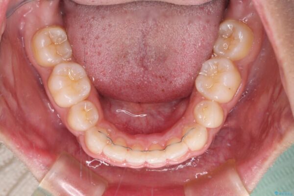 口がしっかりと閉じられない　ワイヤー装置での抜歯矯正で出っ歯を改善 治療後画像