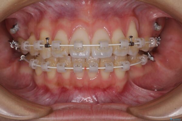 【モニター】気になる八重歯を素早く改善　ワイヤー装置での抜歯矯正 治療途中画像