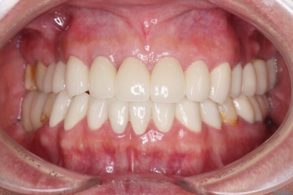 憧れの白い歯に　全顎セラミック治療 治療後画像