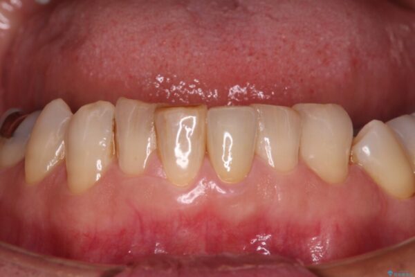 抜歯が必要と言われた前歯　根管治療とオールセラミッククラウン アフター