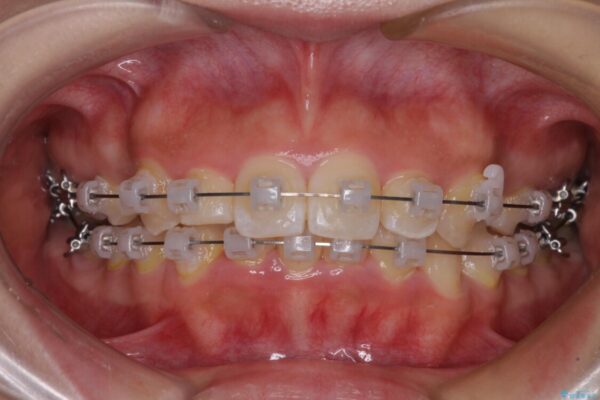 【モニター】八重歯とデコボコをスッキリきれいに　ワイヤー装置での抜歯矯正 治療途中画像