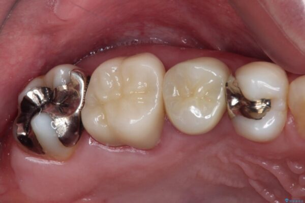 奥歯が痛い　セラミッククラウンでの虫歯治療 治療後画像
