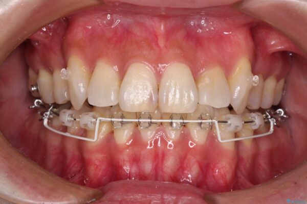 気になる八重歯を目立たない装置で改善　ハーフリンガル矯正 治療途中画像