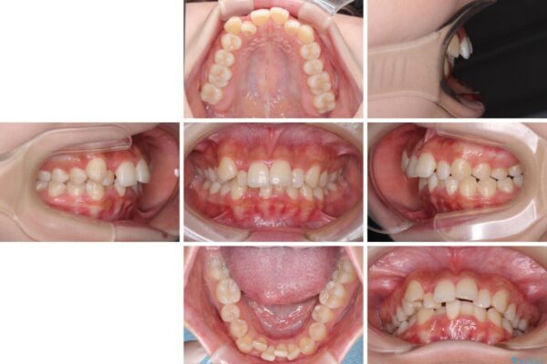 【モニター】八重歯とデコボコをスッキリきれいに　ワイヤー装置での抜歯矯正 治療前画像