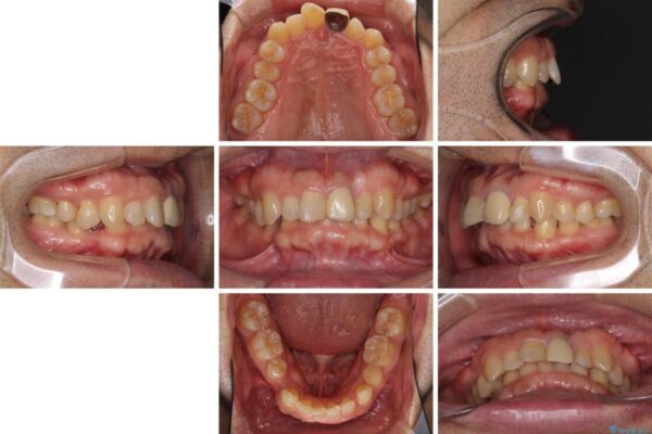 欠損歯列の矯正治療とインプラント治療 治療前画像
