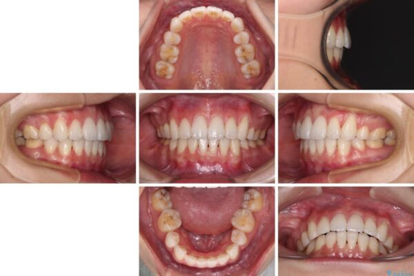 【モニター】気になる八重歯を素早く改善　ワイヤー装置での抜歯矯正 治療後画像