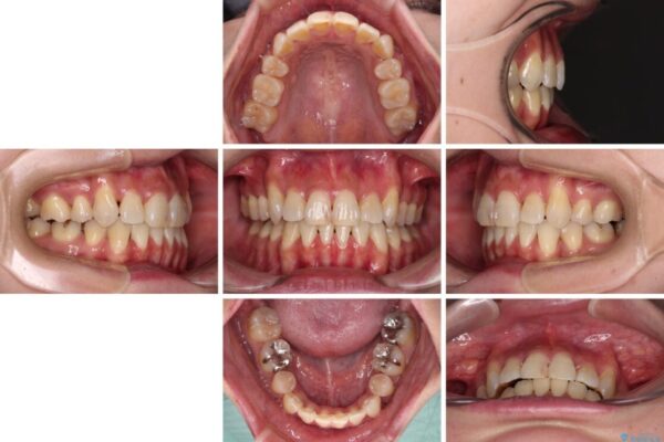 気になる八重歯を目立たない装置で改善　ハーフリンガル矯正 治療後画像