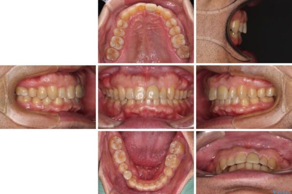 欠損歯列の矯正治療とインプラント治療 治療後画像