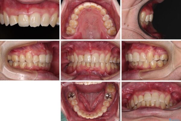 前歯が折れたついでに歯並びも改善　矯正治療と前歯のセラミック治療 治療後画像