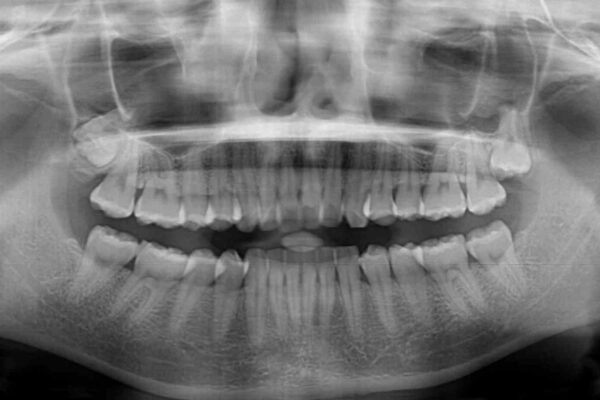 【モニター】飛び出した上顎前歯のワイヤー矯正で改善 治療前画像