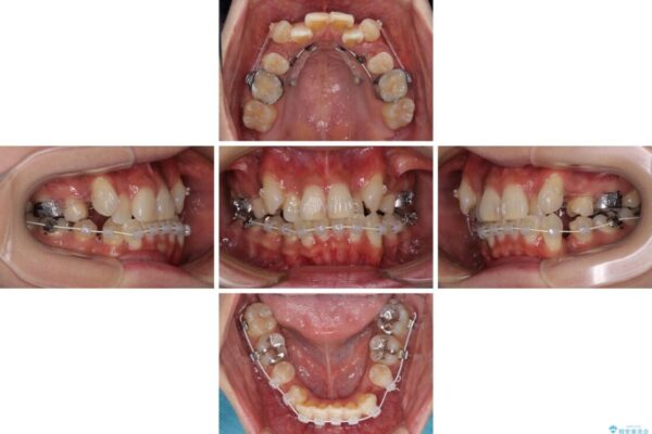 気になる八重歯を目立たない装置で改善　ハーフリンガル矯正 治療途中画像
