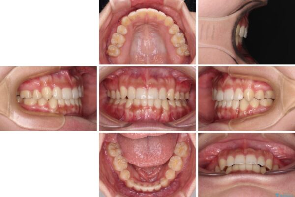 著しい八重歯が気になる　インビザラインによる抜歯矯正治療(ワイヤー装置併用) 治療後画像