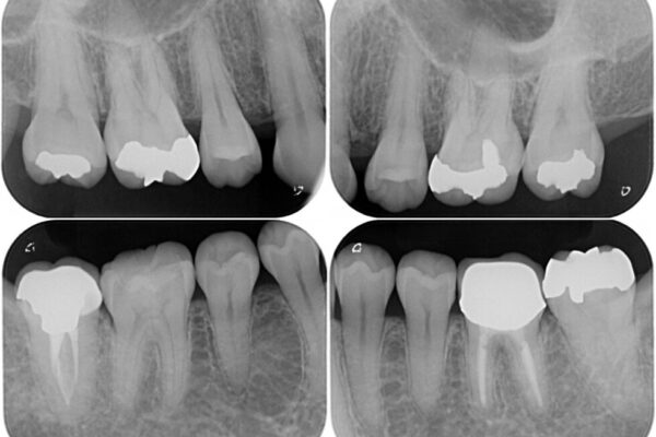 抜歯矯正の後戻りでできたスペース　インビザライン矯正とセラミック治療 治療前画像