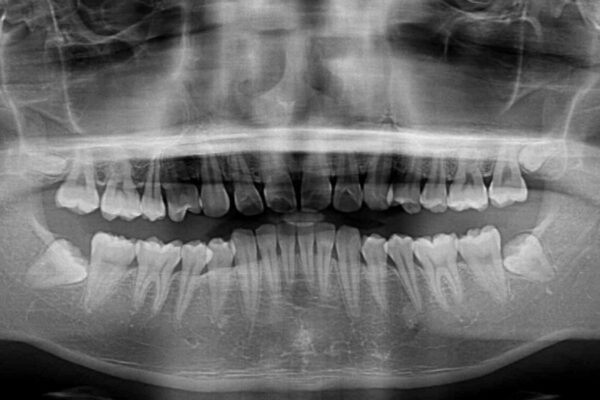 強い咬み合わせで飛び出した前歯　インビザライン矯正で改善(ワイヤー装置併用) 治療前画像