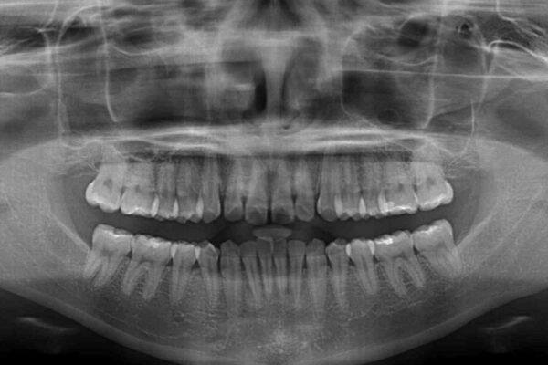 【モニター】すきっ歯をインビザラインで解消 治療前画像