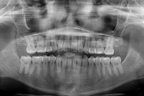 【モニター】八重歯とデコボコをスッキリきれいに　ワイヤー装置での抜歯矯正 治療後画像