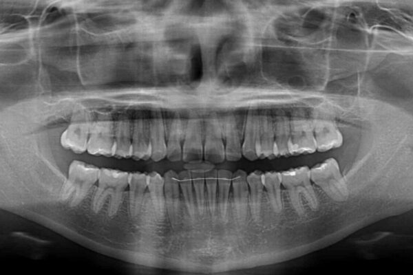 【モニター】すきっ歯をインビザラインで解消 治療後画像
