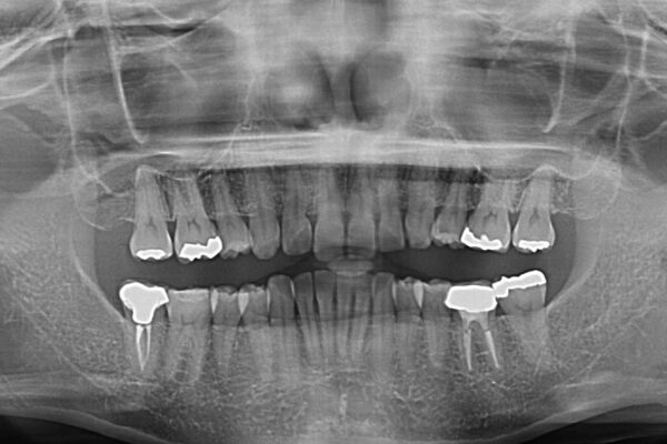 抜歯矯正の後戻りでできたスペース　インビザライン矯正とセラミック治療 治療前画像
