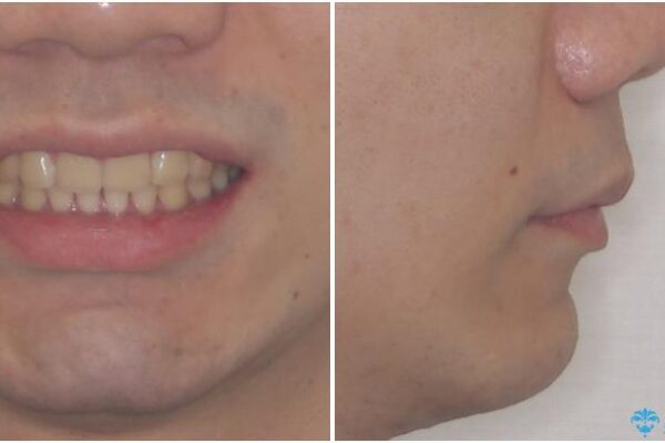 強い咬み合わせで飛び出した前歯　インビザライン矯正で改善(ワイヤー装置併用) 治療後画像
