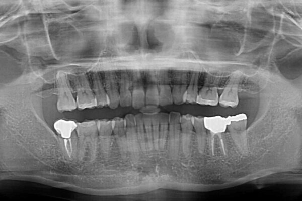 抜歯矯正の後戻りでできたスペース　インビザライン矯正とセラミック治療 治療後画像