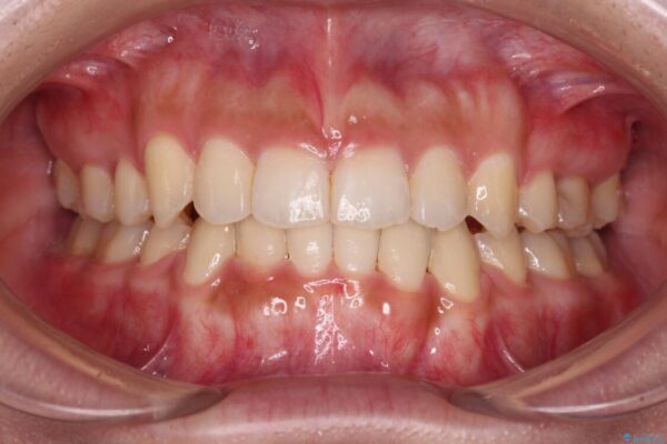 著しい八重歯が気になる　インビザラインによる抜歯矯正治療(ワイヤー装置併用) アフター