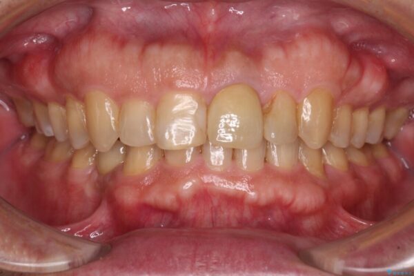 欠損歯列の矯正治療とインプラント治療 アフター