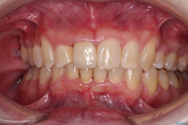 前歯が折れたついでに歯並びも改善　矯正治療と前歯のセラミック治療 アフター