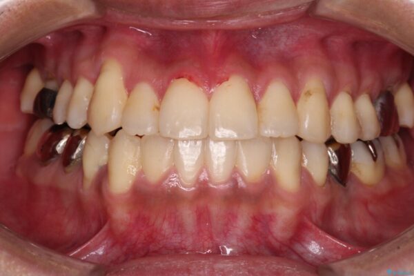前歯のクロスバイトを改善　インビザライン矯正 アフター