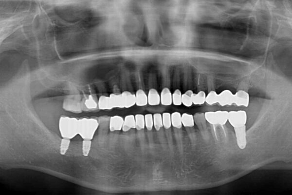 憧れの白い歯に　全顎セラミック治療 治療後画像