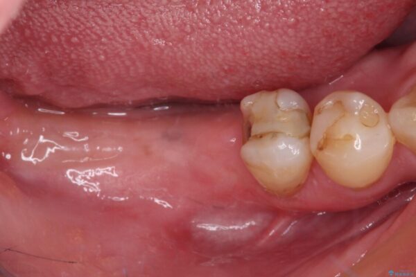 憧れの白い歯に　全顎セラミック治療 治療途中画像