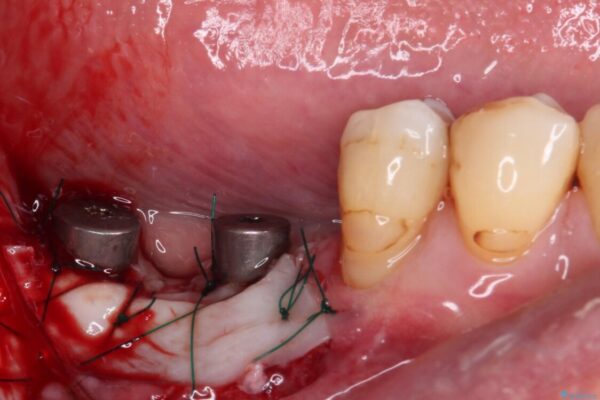 憧れの白い歯に　全顎セラミック治療 治療途中画像