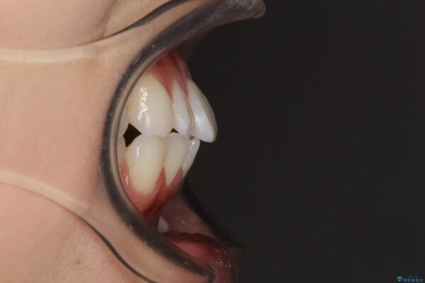 【モニター】気になる八重歯を素早く改善　ワイヤー装置での抜歯矯正 治療前画像