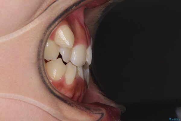 著しい八重歯が気になる　インビザラインによる抜歯矯正治療(ワイヤー装置併用) 治療前画像